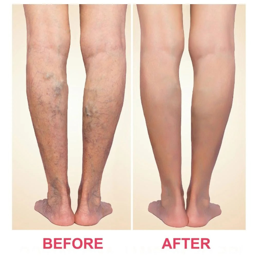 Varicose Veins Patch