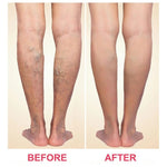 Varicose Veins Patch