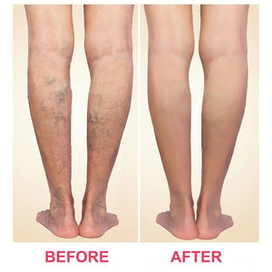 Varicose Veins Patch